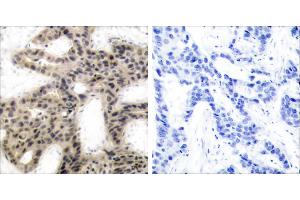 P-Peptide - +Immunohistochemical analysis of paraffin-embedded human breast carcinoma tissue using 4E-BP1 (phospho-Thr45) antibody. (eIF4EBP1 Antikörper  (pThr45))