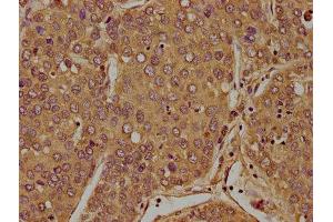 IHC image of ABIN7152998 diluted at 1:100 and staining in paraffin-embedded human liver cancer performed on a Leica BondTM system. (FLCN Antikörper  (AA 291-579))