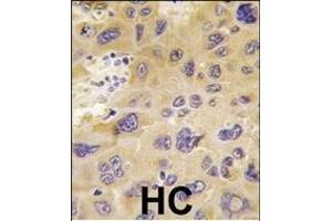 Formalin-fixed and paraffin-embedded human hepatocarcinoma tissue reacted with PFKFB1 antibody (N-term), which was peroxidase-conjugated to the secondary antibody, followed by DAB staining. (PFKFB1 Antikörper  (N-Term))