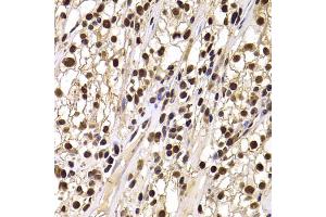 Immunohistochemistry of paraffin-embedded human kidney cancer using HIRIP3 antibody (ABIN5974221) at dilution of 1/100 (40x lens). (HIRIP3 Antikörper)