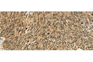 Immunohistochemistry of paraffin-embedded Human lung cancer tissue using PSMD10 Polyclonal Antibody at dilution 1:40 (PSMD10 Antikörper)