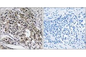 Immunohistochemistry analysis of paraffin-embedded human breast carcinoma tissue, using MRPL13 Antibody. (MRPL13 Antikörper  (AA 121-170))