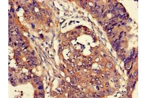 Immunohistochemistry of paraffin-embedded human colon cancer using ABIN7165226 at dilution of 1:100 (CUTA Antikörper  (AA 33-150))