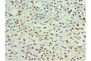 Immunohistochemistry of paraffin-embedded human breast cancer using ABIN7147984 at dilution of 1:100 (COTL1 Antikörper  (AA 1-142))