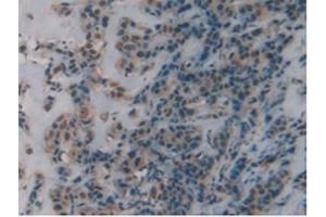 IHC-P analysis of Human Breast Cancer Tissue, with DAB staining. (DBH Antikörper  (AA 335-571))