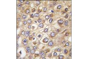 Formalin-fixed and paraffin-embedded human hepatocarcinoma tissue reacted with CLDN2 (Human N-term), which was peroxidase-conjugated to the secondary antibody, followed by DAB staining. (Claudin 2 Antikörper  (N-Term))