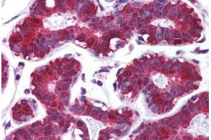 Human Breast (formalin-fixed, paraffin-embedded) stained with PDCD4 antibody ABIN213965 at 5 ug/ml followed by biotinylated goat anti-rabbit IgG secondary antibody ABIN481713, alkaline phosphatase-streptavidin and chromogen. (PDCD4 Antikörper  (C-Term))