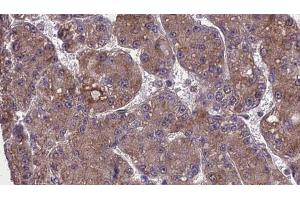 ABIN6274001 at 1/100 staining Human liver cancer tissue by IHC-P.