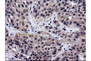 Immunohistochemical staining of paraffin-embedded Carcinoma of Human bladder tissue using anti-DNAJB1 mouse monoclonal antibody. (DNAJB1 Antikörper)