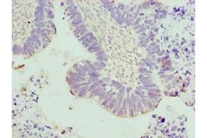 Immunohistochemistry of paraffin-embedded human ovarian cancer using ABIN7173667 at dilution of 1:100 (TUBA3E Antikörper  (AA 1-250))