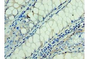 Immunohistochemistry of paraffin-embedded human colon cancer using ABIN7166935 at dilution of 1:100 (RSPO1 Antikörper  (AA 21-263))