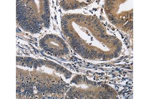 Immunohistochemistry of Human colon cancer using IL2RB Polyclonal Antibody at dilution of 1:60 (IL2 Receptor beta Antikörper)
