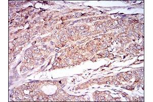 Immunohistochemical analysis of paraffin-embedded prostate cancer tissues using CAMK2G mouse mAb with DAB staining. (CAMKII gamma Antikörper  (AA 322-481))