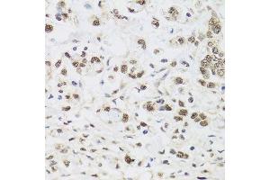 Immunohistochemistry of paraffin-embedded human gastric cancer using PPP1CC antibody. (PPP1CC Antikörper  (AA 1-323))
