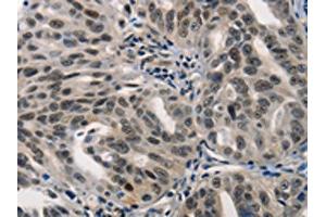 The image on the left is immunohistochemistry of paraffin-embedded Human ovarian cancer tissue using ABIN7190002(BPIFB1 Antibody) at dilution 1/40, on the right is treated with synthetic peptide. (BPIFB1 Antikörper)