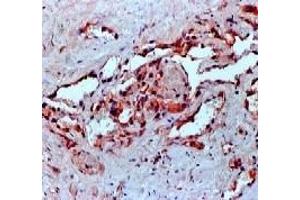 Formalin fixed paraffin embedded human angiosarcoma stained with VEGF antibody (VEGFA Antikörper)