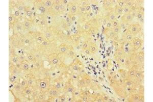 Immunohistochemistry of paraffin-embedded human liver cancer using ABIN7175178 at dilution of 1:100 (UVRAG Antikörper  (AA 375-425))