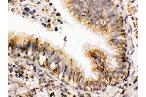 Anti- ERp57 Picoband antibody,IHC(P) IHC(P): Human Lung Cancer Tissue (PDIA3 Antikörper  (C-Term))