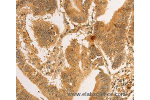 Immunohistochemistry of Human lung cancer using RPL26L1 Polyclonal Antibody at dilution of 1:30 (RPL26L1 Antikörper)