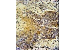 MRPS24 antibody (Center) (ABIN654454 and ABIN2844188) immunohistochemistry analysis in formalin fixed and paraffin embedded human lung carcinoma followed by peroxidase conjugation of the secondary antibody and DAB staining. (MRPS24 Antikörper  (AA 21-50))