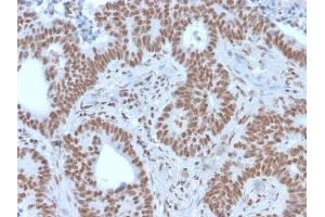Formalin-fixed, paraffin-embedded human colon carcinoma stained with NRF1 Mouse Monoclonal Antibody (NRF1/2609). (NFE2L1 Antikörper)