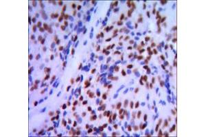 Immunohistochemical analysis of paraffin-embedded pancreatic cancer, using GATA1 mouse mAb with DAB staining.