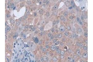 IHC-P analysis of Human Breast cancer Tissue, with DAB staining. (D2HGDH Antikörper  (AA 56-232))