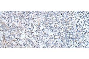 Immunohistochemistry of paraffin-embedded Human tonsil tissue using ABCD1 Polyclonal Antibody at dilution of 1:80(x200) (ABCD1 Antikörper)