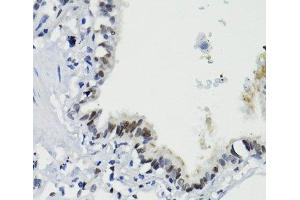 Immunohistochemistry of paraffin-embedded Human lung using Phospho-Stat3(S727) Polyclonal Antibody at dilution of 1:100 (40x lens). (STAT3 Antikörper  (pSer727))