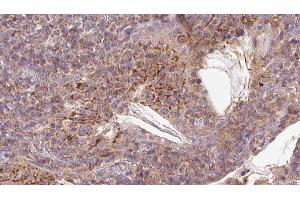 ABIN6273055 at 1/100 staining Human lymph cancer tissue by IHC-P.