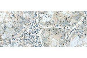 Immunohistochemistry of paraffin-embedded Human colorectal cancer tissue using PAK1IP1 Polyclonal Antibody at dilution of 1:120(x200) (PAK1IP1 Antikörper)