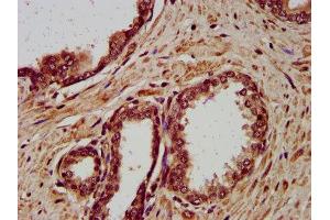 IHC image of ABIN7149771 diluted at 1:400 and staining in paraffin-embedded human prostate cancer performed on a Leica BondTM system.