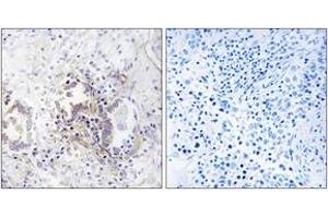 Immunohistochemistry analysis of paraffin-embedded human lung carcinoma tissue, using CHML Antibody.