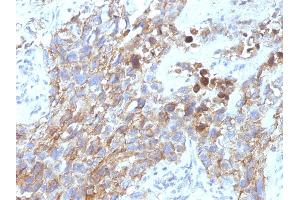 Formalin-fixed, paraffin-embedded human Lung Carcinoma stained with CD56 Mouse Monoclonal Antibody (NCAM1/795). (CD56 Antikörper)