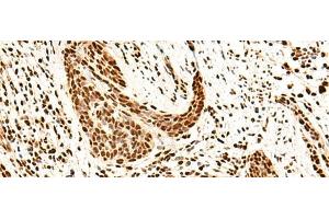 Immunohistochemistry of paraffin-embedded Human esophagus cancer tissue using SNRPB2 Polyclonal Antibody at dilution of 1:75(x200) (SNRPB2 Antikörper)