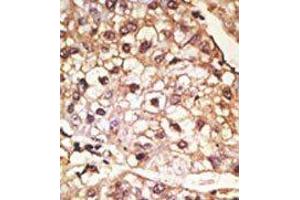 Formalin-fixed and paraffin-embedded human cancer tissue reacted with the primary antibody, which was peroxidase-conjugated to the secondary antibody, followed by AEC staining. (SNCA Antikörper  (C-Term))