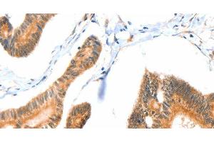 Immunohistochemistry of paraffin-embedded Human colon cancer tissue using ACOX3 Polyclonal Antibody at dilution 1:35