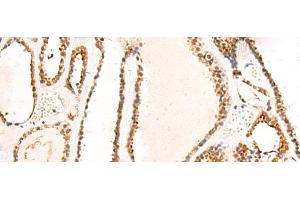 Immunohistochemistry of paraffin-embedded Human thyroid cancer tissue using DCAF10 Polyclonal Antibody at dilution of 1:130(x200)