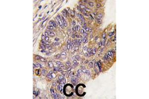 Formalin-fixed and paraffin-embedded human colon carcinoma tissue reacted with RPS6KA1 polyclonal antibody  , which was peroxidase-conjugated to the secondary antibody, followed by DAB staining. (RPS6KA1 Antikörper  (Ser732))