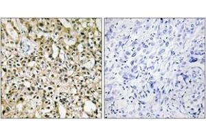 Immunohistochemistry analysis of paraffin-embedded human liver carcinoma tissue, using MYC Antibody. (c-MYC Antikörper  (AA 386-435))