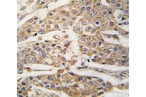 IHC analysis of FFPE human breast carcinoma tissue stained with PKM2 antibody (PKM2 Antikörper  (AA 460-489))