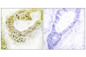 Immunohistochemistry analysis of paraffin-embedded human colon carcinoma tissue using ZNF638 antibody. (ZNF638 Antikörper  (Internal Region))
