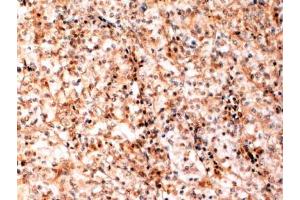 ABIN184741 (2 µg/mL) staining of paraffin embedded Human Kidney cancer. (TFEB Antikörper  (N-Term))