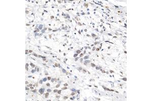Immunohistochemistry of paraffin-embedded human esophageal cancer using [KO Validated] L3MBTL3 Rabbit pAb (ABIN6132145, ABIN6143061, ABIN6143062 and ABIN6223119) at dilution of 1:50 (40x lens).