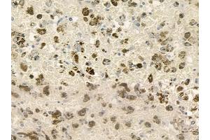 ABIN6260720 and ABIN6276822 at 1/100 staining human melanoma by IHC-P.