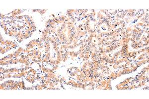 Immunohistochemistry of paraffin-embedded Human thyroid cancer tissue using Ephrin A1 Polyclonal Antibody at dilution 1:37 (Ephrin A1 Antikörper)