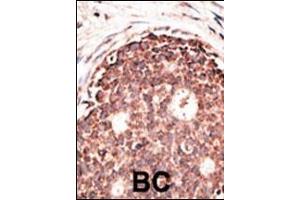 Formalin-fixed and paraffin-embedded human cancer tissue reacted with the primary antibody, which was peroxidase-conjugated to the secondary antibody, followed by DAB staining. (MMP 9 Antikörper  (C-Term))