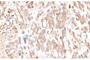 Immunohistochemistry of paraffin-embedded Human gastric cancer using CDH11 Polyclonal Antibody at dilution of 1:100 (40x lens). (OB Cadherin Antikörper)