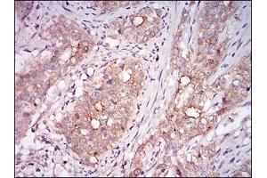 Immunohistochemical analysis of paraffin-embedded cervical cancer tissues using MSTN mouse mAb with DAB staining. (MSTN Antikörper  (AA 24-266))
