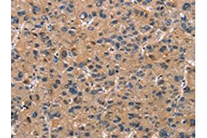 The image on the left is immunohistochemistry of paraffin-embedded Human liver cancer tissue using ABIN7189936(ATP7A Antibody) at dilution 1/50, on the right is treated with synthetic peptide. (ATP7A Antikörper)